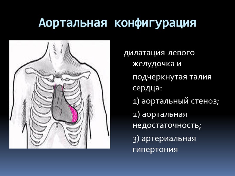 Аортальная конфигурация дилатация левого желудочка и        подчеркнутая